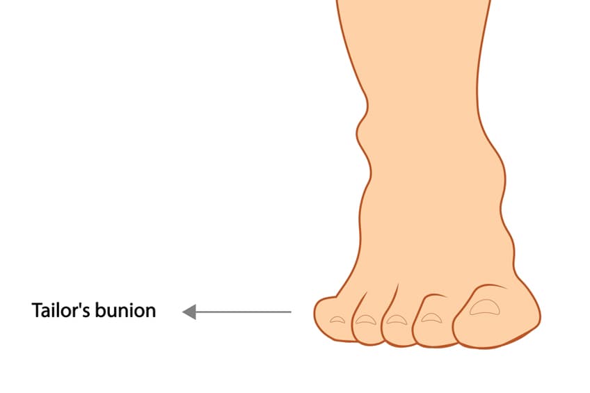 Explore every step of Tailor's Bunion surgery, from consultation to recovery. Get insights on what to expect, healing tips, and how to manage post-surgery care for a smooth journey.