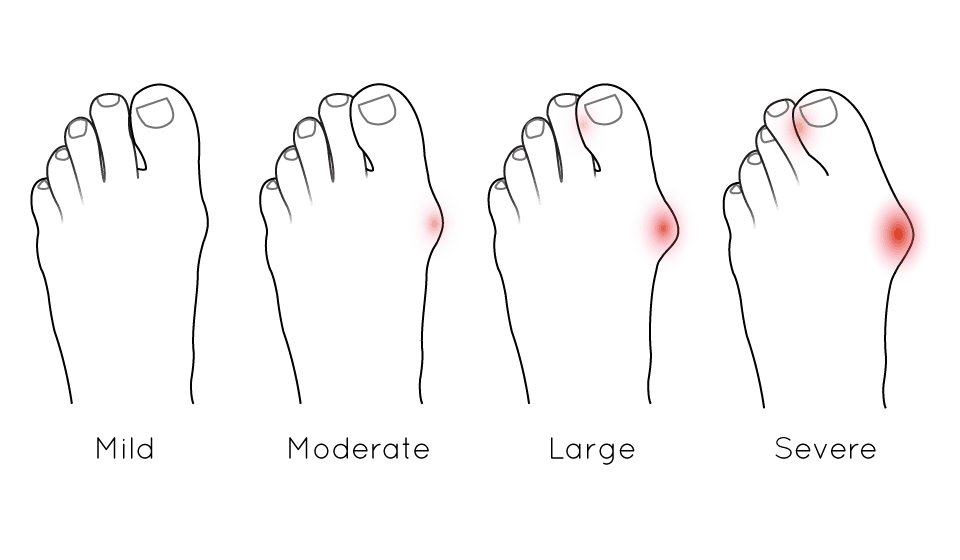 Image showing how Bunions progress from mild to severe