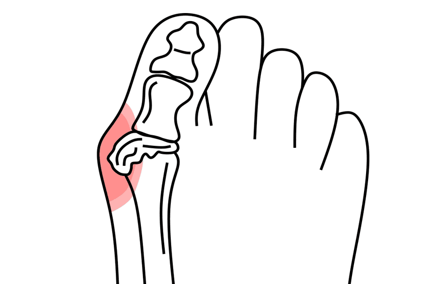 Get ready for a smooth bunion surgery recovery with our comprehensive checklist. From pre-op tips to post-op essentials, ensure a stress-free experience. Consult your doctor today!