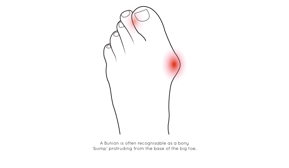 Image of bunion demonstrating where the pain is and how to recognise