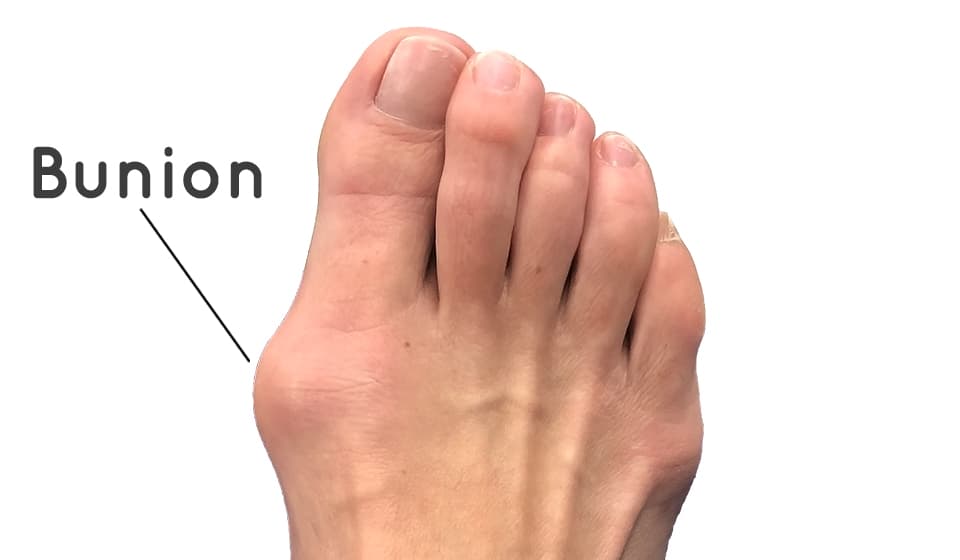 Image of bunion