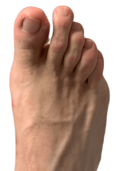 Eight weeks post-operative Bunion image