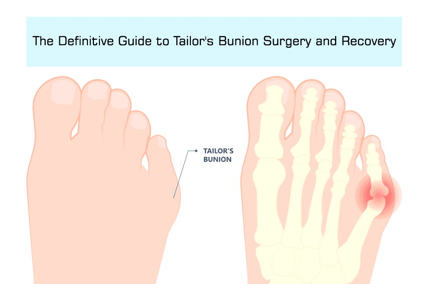 Tailor’s bunion surgery removes painful bumps near the little toe, improving foot function. Learn about the procedure, recovery tips, and how to regain comfort post-surgery.
