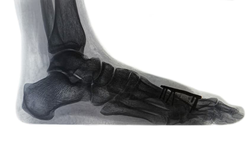 Enhance mobility and reduce pain with the Lapidus procedure. This surgical solution corrects bunion deformities, restoring foot alignment for long-term comfort and improved function.